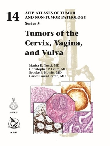 Tumors the cervix vagina - tumors, cervix,